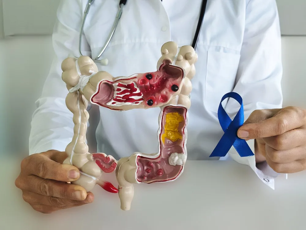 Doctor holding colorectal anatomy model and blue bowel cancer awareness ribbon